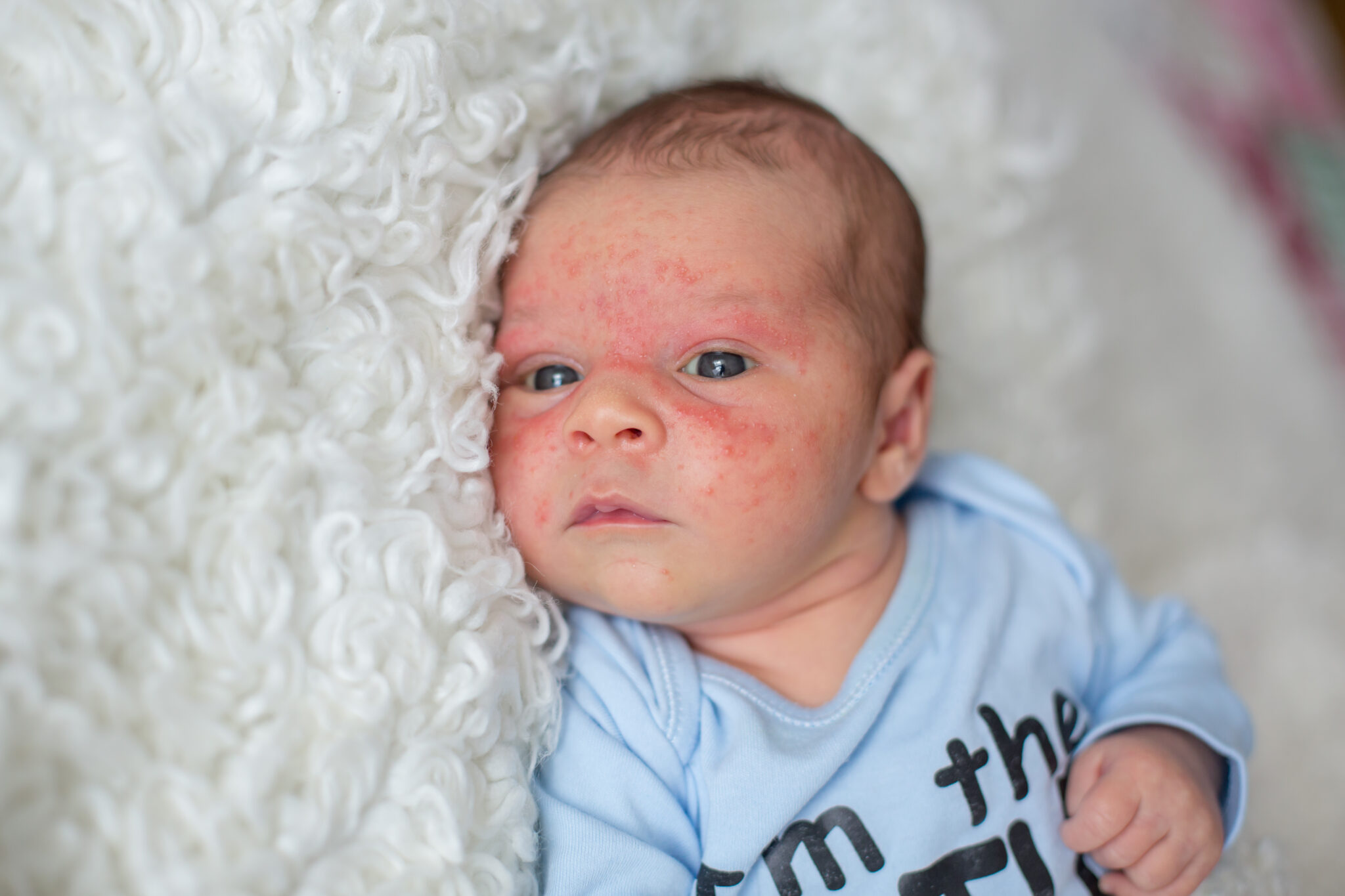atopik dermatit cilt nedir bebeklerde atopik dermatit neden olur