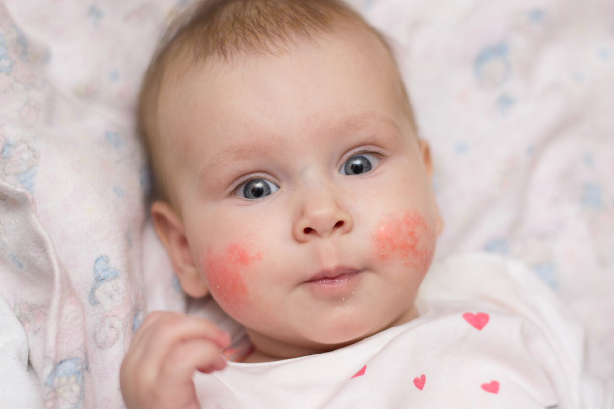 Atopik Dermatit Cilt Nedir? Bebeklerde Atopik Dermatit Neden Olur?